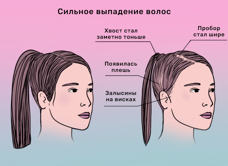 Причины выпадения волос